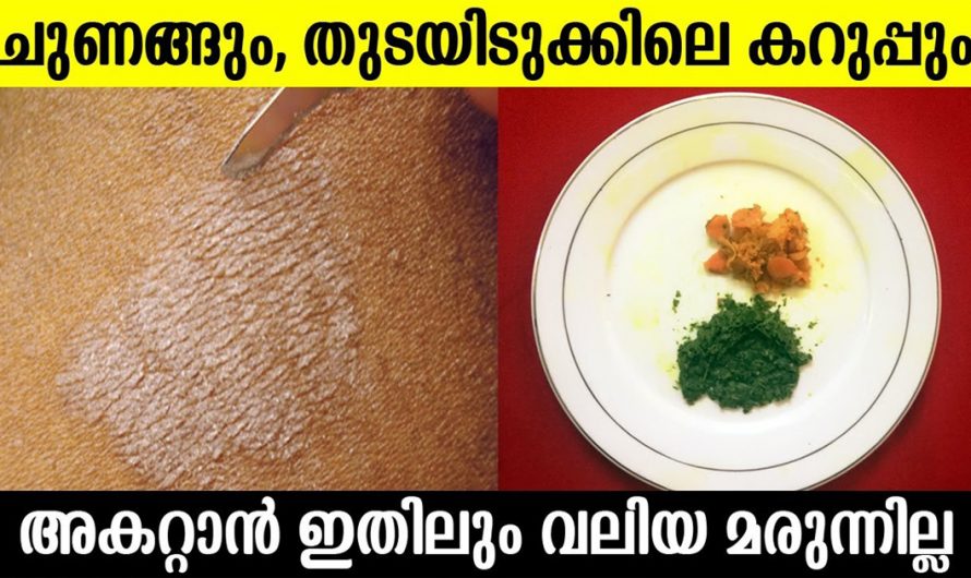 ഇനി ആരും തന്നെ ഇതുകൊണ്ട് ബുദ്ധിമുട്ടേണ്ട ആവശ്യമില്ല. ചുണങ്ങിനും തുടയിടുക്കിലെ കറുപ്പ് മാറ്റാനും ഇതാ ഫലപ്രദമായ മാർഗം. | How To Get Rid of Tinea Versicolor