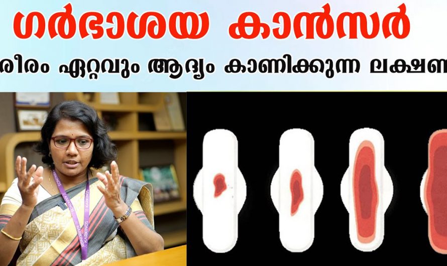 സ്ത്രീകൾക്ക് ഈ ലക്ഷണങ്ങൾ അനുഭവപ്പെടുന്നുണ്ടെങ്കിൽ അത് ഗർഭാശയ കാൻസർ കാരണമാണ്. | Uterine Cancer Symptoms