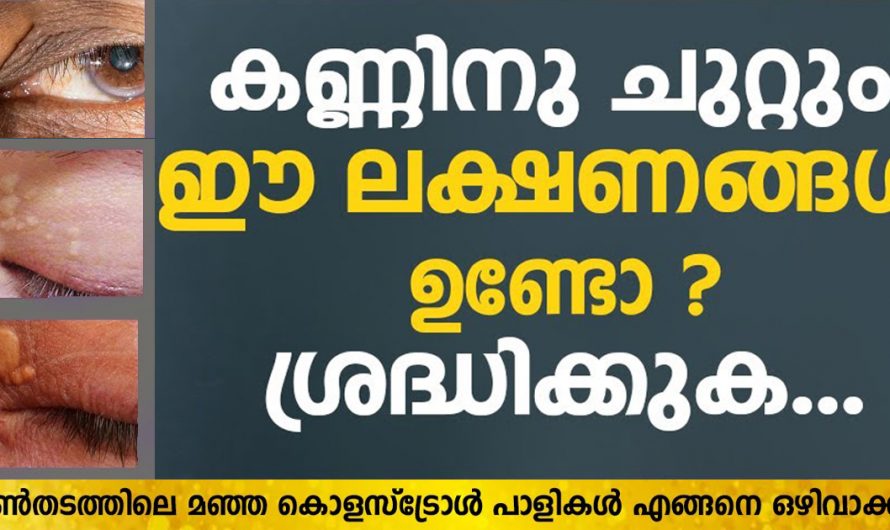 കണ്ണിന്റെ ഈ പ്രശ്നത്തെ ഇനിയാരും നിസ്സാരമായി കാണരുത്. ഉടനെ തന്നെ ഇതുപോലെ ചെയ്യൂ. | Xanthelasma Removal Malayalam