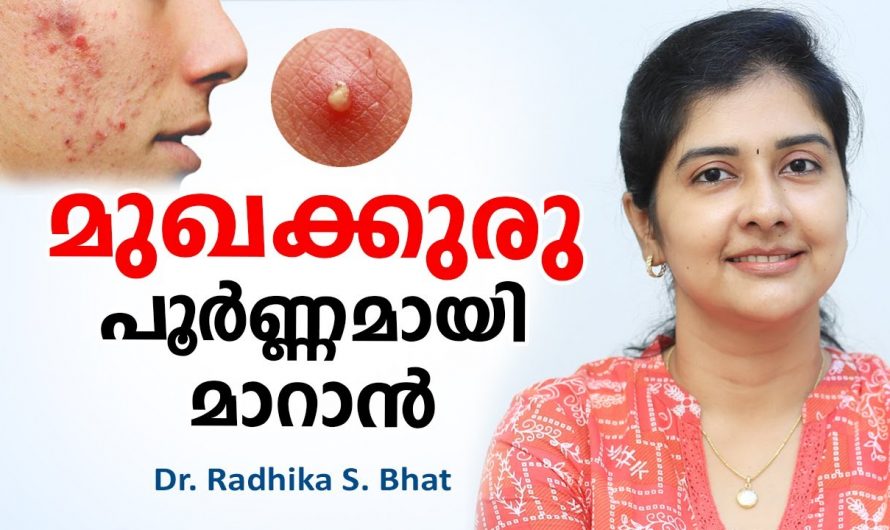 മുഖക്കുരു പൂർണമായി മാറാൻ ഇതുപോലെ ചെയ്യൂ. | Face Care Tip