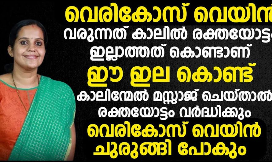 വെരിക്കോസ് വെയിൻ വന്നാൽ ഓപ്പറേഷൻ ഇല്ലാതെ പൂർണ്ണമായി മാറ്റാം. ഇതുപോലെ ചെയ്താൽ മതി. | Varicose veins can be completely reversed