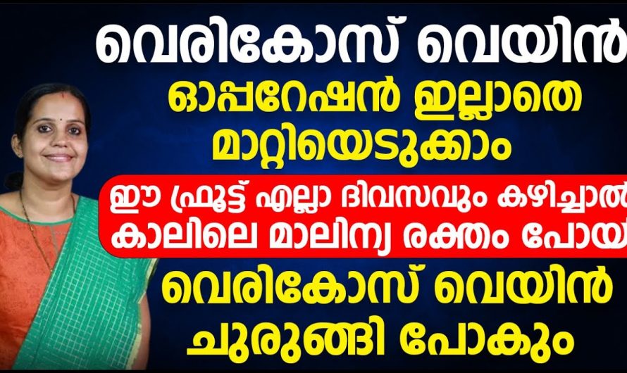 വെരിക്കോസ് വെയിൻ ഓപ്പറേഷൻ ഇല്ലാതെ മാറ്റണോ? എന്നാൽ ഡോക്ടർ പറയുന്നതുപോലെ ചെയ്താൽ മതി. | Varicose veins replaced without surgery