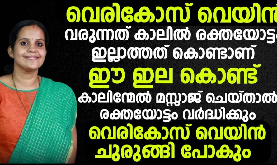 വെരിക്കോസ് വെയിൻ ഇനി ജീവിതത്തിൽ വരില്ല .. ഇതറിയാമെങ്കിൽ