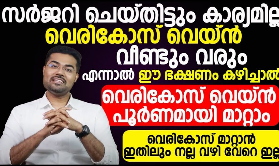 ഇനി വെരിക്കോസ് വെയിൻ കാരണം ബുദ്ധിമുട്ടേണ്ട.. നിങ്ങൾക്കും ഉപയോഗിക്കാം ഈ രീതി