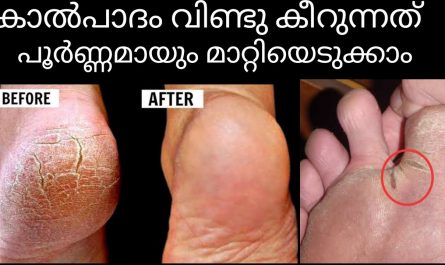 cracked Heels home remedy