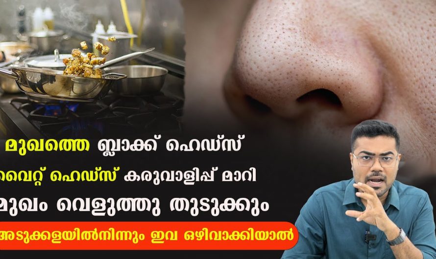 ഈ ഭക്ഷണങ്ങൾ കഴിക്കുന്നത് ഒഴിവാക്കിയാൽ തന്നെ മുഖത്തെ ബ്ലാക്ക് ഹെഡ്സും വൈറ്റ് ഹെഡ്സും ഇല്ലാതാകുന്നതായിരിക്കും. | Remove Black And White Heads