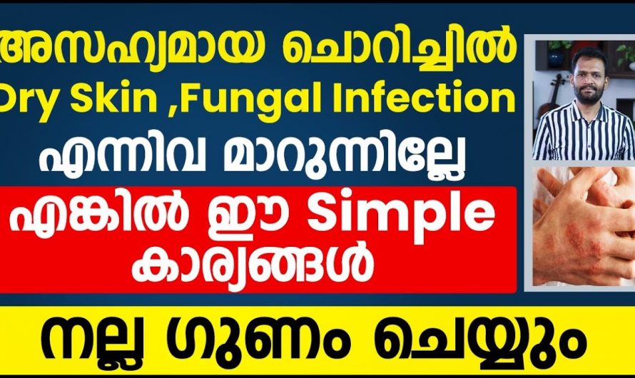 ചൊറിച്ചിൽ, ഫംഗൽ ഇൻഫെക്ഷൻ, ഡ്രൈ സ്കിൻ എന്നിവ മാറുന്നില്ലെങ്കിൽ ഇങ്ങനെ ചെയ്തു നോക്കൂ. എളുപ്പത്തിൽ മാറ്റിയെടുക്കാം. | Remove Fungal infection and dry skin