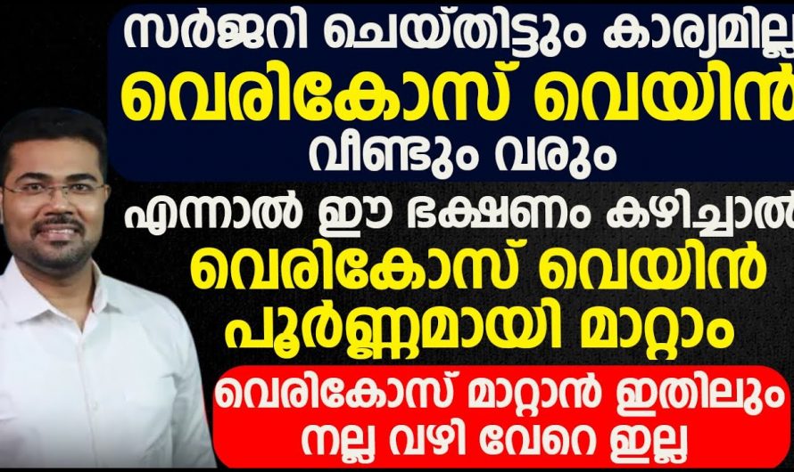 സർജറി ചെയ്തിട്ടും കാര്യമില്ല വെരിക്കോസ് വെയിൻ വീണ്ടും വരുന്നുണ്ടോ ഇതാണ് കാരണം. | Even after surgery varicose veins will come back