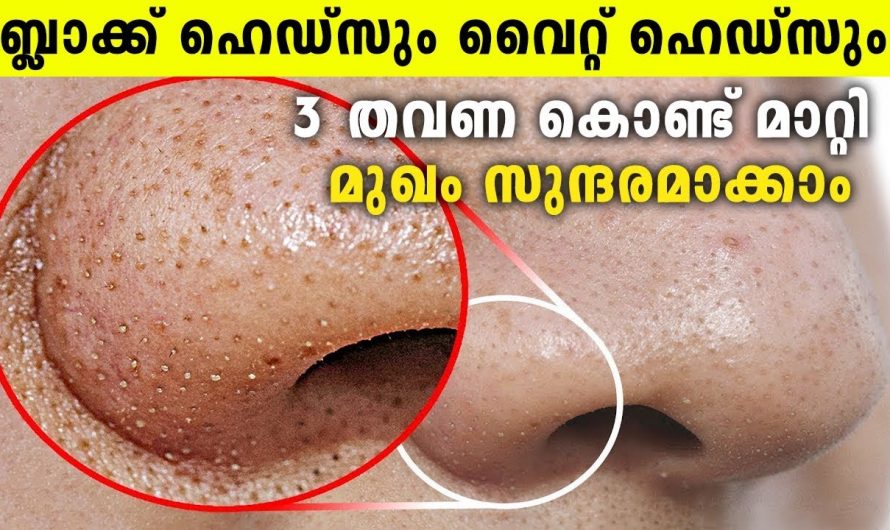 വെറും മൂന്ന് തവണ ഇതുപോലെ ചെയ്താൽ ബ്ലാക്ക് ഹെഡ്സും വൈറ്റ് ഹെഡ്സും മാറ്റി മുഖം സുന്ദരം ആക്കാം. | Remove Black Heads In Easy way