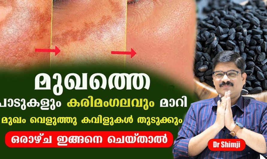 ഇവയെല്ലാമാണ് പ്രധാനമായും മുഖക്കുരുവിന്റെ കാരണങ്ങൾ,ഈ കാര്യങ്ങൾ ശ്രദ്ധിച്ചില്ലെങ്കിൽ മുഖക്കുരുവും കറുത്ത പാടുകളും ഒരിക്കലും മായില്ല…