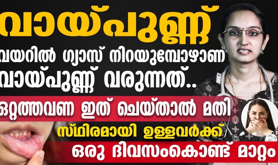 വായ്പുണ്ണ് പൂർണമായും മാറാൻ വീട്ടിൽ ഈ ഒരു കാര്യം ചെയ്തു നോക്കൂ…