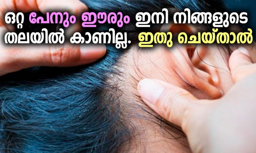 പേനും ഈരും അകറ്റാൻ ഈ ഒറ്റമൂലി ഒരു പ്രാവശ്യം തലയിൽ തേച്ചാൽ മതി …