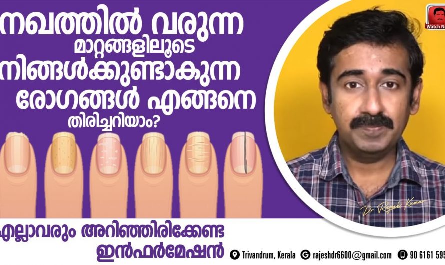 നഖങ്ങളിലെ ഈ നിറവ്യത്യാസങ്ങൾ തിരിച്ചറിയൂ, അവ പറയും നിങ്ങളുടെ ആരോഗ്യം….