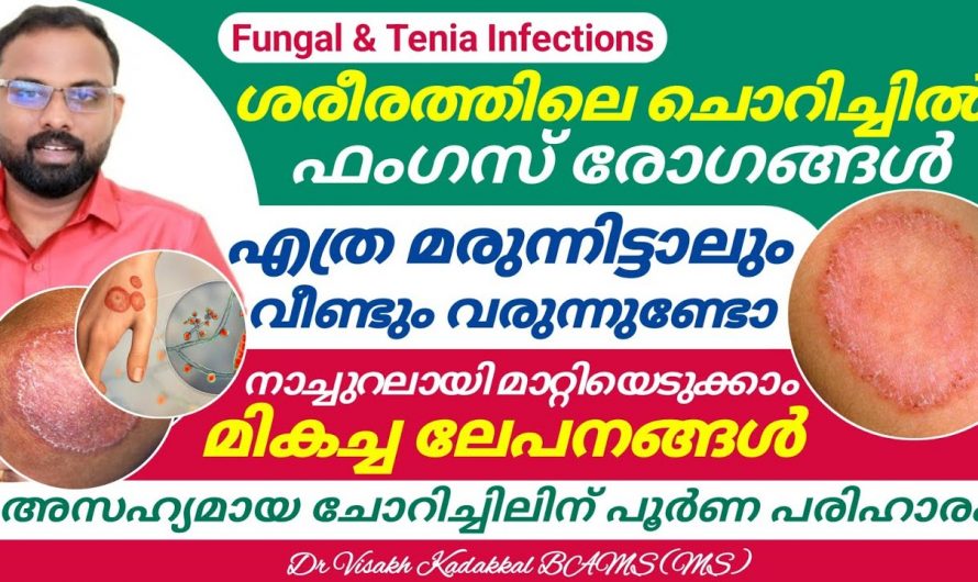 ചൊറിച്ചിൽ കൊണ്ട് ബുദ്ധിമുട്ടുന്നവർ ഉടൻതന്നെ ഇത് ചെയ്യൂ, ഫംഗസ് അണുബാധ പൂർണമായും മാറും…