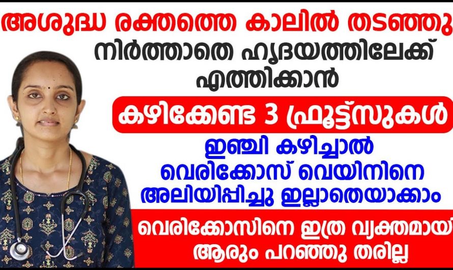 വെരിക്കോസ് വെയിൻ ഉണ്ടാവുന്നതിന്റെ കാരണം അറിയാതെ ചികിത്സിച്ചിട്ട് കാര്യമില്ല, ഇത് കേൾക്കൂ…