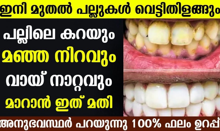 പല്ലുകൾ പളുങ്ക് പോലെ വെളുക്കാൻ ഇതാ ഒരു കിടിലൻ വിദ്യ…