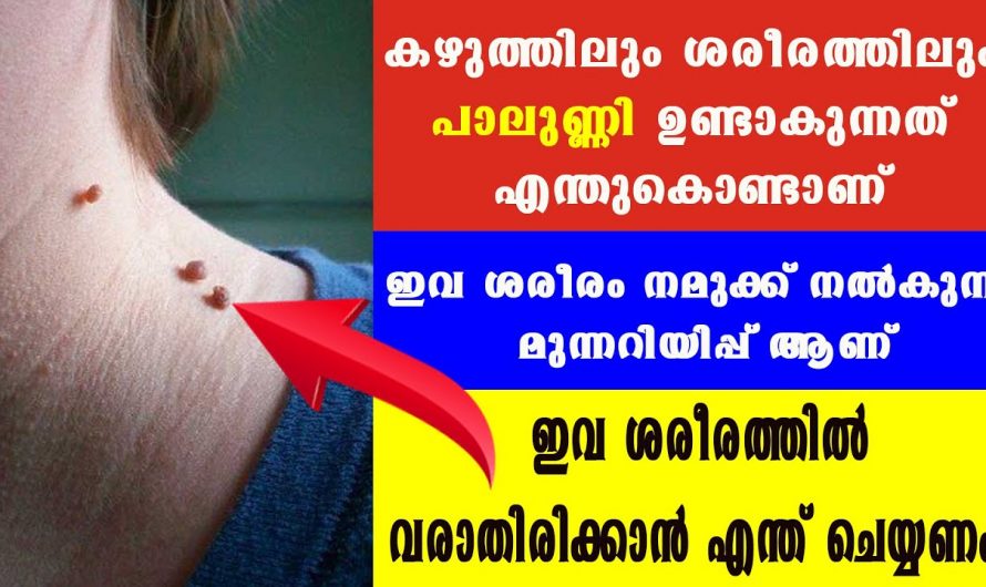 ചർമ്മത്തിൽ പാലുണ്ണി ഉള്ളവർ ഉറപ്പായും ഈ കാര്യം അറിഞ്ഞിരിക്കണം, ഡോക്ടർ നൽകുന്ന അറിവ്…